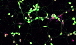Human Aging Medium Spiny Neuron